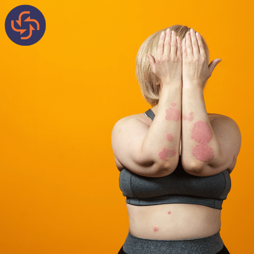 Overweight woman in sportswear covering her face with hands, showing red scaly psoriasis patches on her arms and body against an orange background.