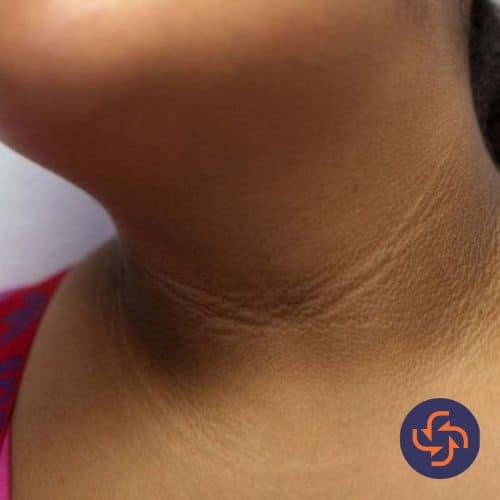 Close-up of a woman’s neck with dark skin patches, showing signs of acanthosis nigricans or skin pigmentation disorder.